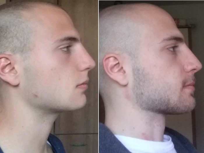 Picture of jaw transformation before and after mewing